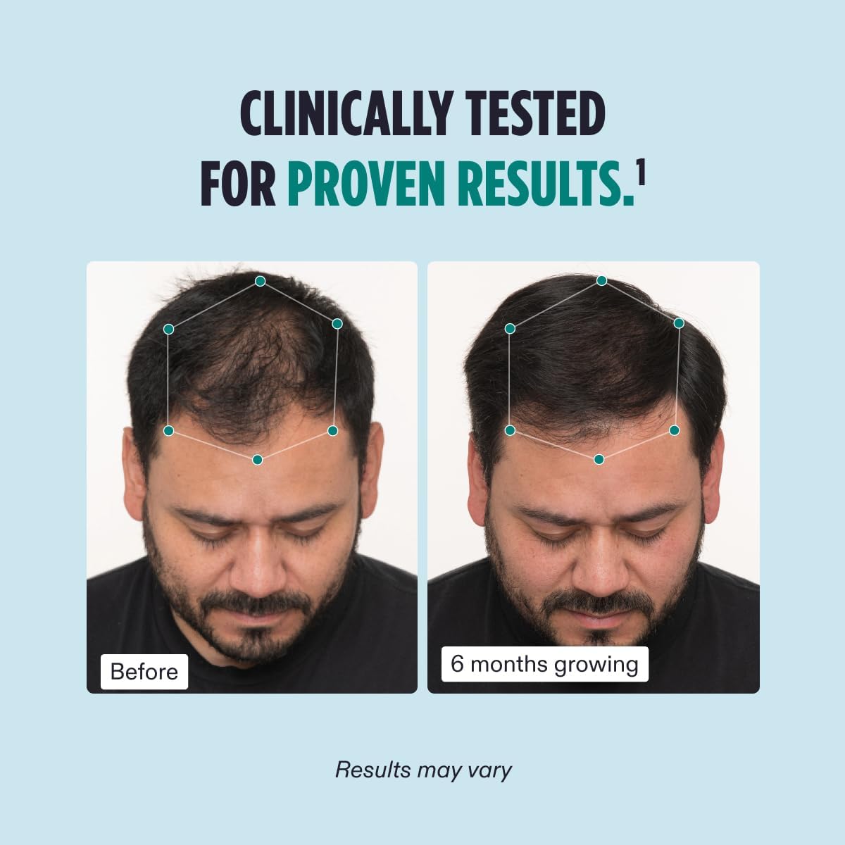 Nutrafol Men Hair Growth Supplement for Thicker, Stronger Hair (4 Capsules Per Day - 1 Month Supply), 120 Count (Pack of 1) 4.0 4.0 out of 5 stars 5,460 ratings | Search this page Amazon's Choice Overall Pick